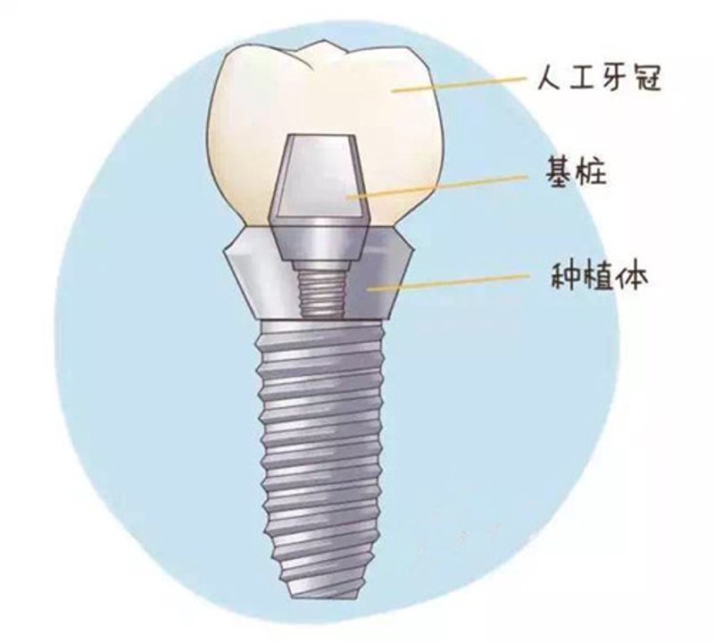 隐形矫正——重塑自信的一抹温柔